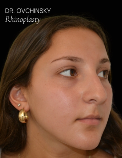 Rhinoplasty Before & After Patient #17594