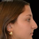 Rhinoplasty Before & After Patient #17594