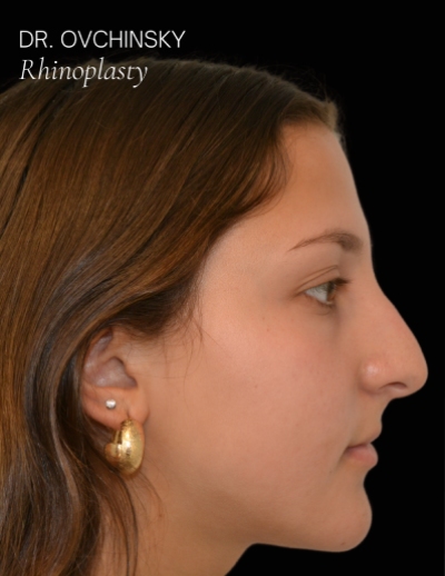 Rhinoplasty Before & After Patient #17594