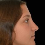 Rhinoplasty Before & After Patient #17594