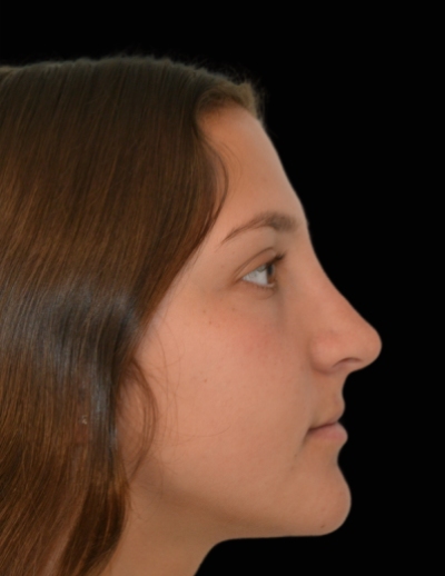 Rhinoplasty Before & After Patient #17594