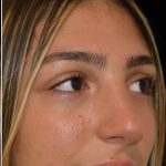 Rhinoplasty Before & After Patient #17705