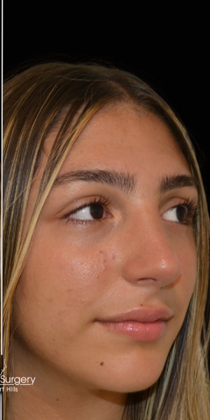 Rhinoplasty Before & After Patient #17705