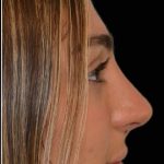 Rhinoplasty Before & After Patient #17705