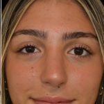 Rhinoplasty Before & After Patient #17705