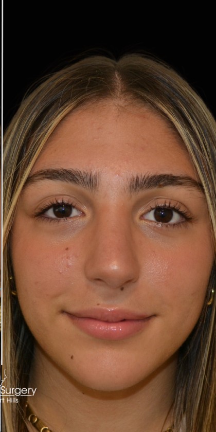 Rhinoplasty Before & After Patient #17705