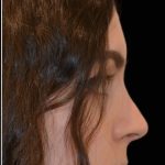 Rhinoplasty Before & After Patient #17706