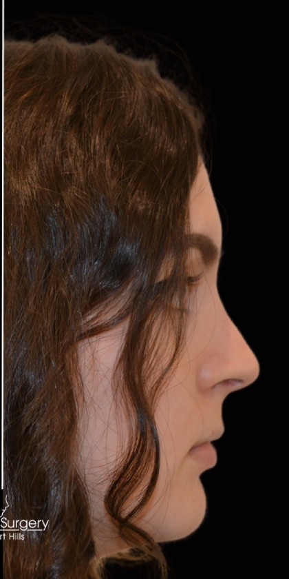 Rhinoplasty Before & After Patient #17706