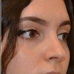 Rhinoplasty Before & After Patient #17706