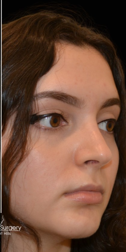 Rhinoplasty Before & After Patient #17706