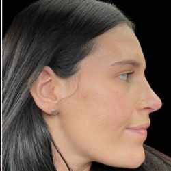 Rhinoplasty Before & After Patient #17699