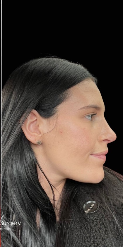 Rhinoplasty Before & After Patient #17699