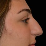 Rhinoplasty Before & After Patient #17705