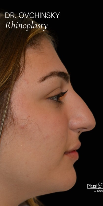 Rhinoplasty Before & After Patient #17705