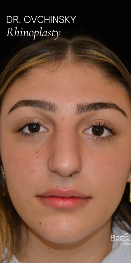 Rhinoplasty Before & After Patient #17705