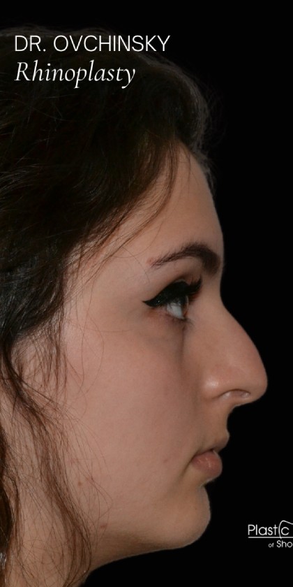 Rhinoplasty Before & After Patient #17706