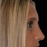 Rhinoplasty Before & After Patient #17677