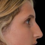 Rhinoplasty Before & After Patient #17677