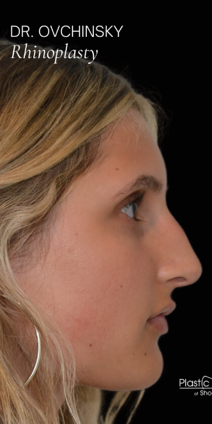 Rhinoplasty Before & After Patient #17677