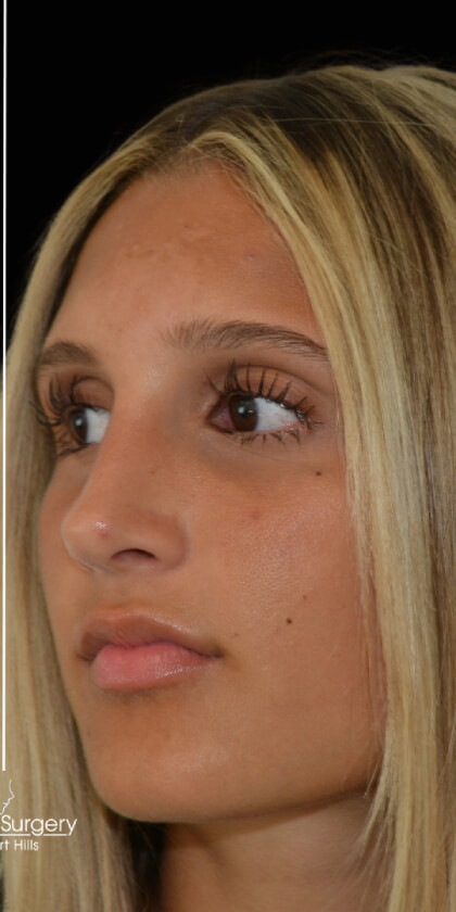 Rhinoplasty Before & After Patient #17677