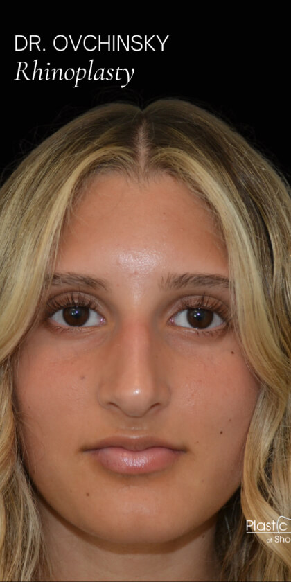 Rhinoplasty Before & After Patient #17677