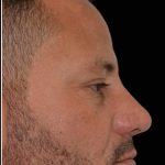 Rhinoplasty Before & After Patient #17759