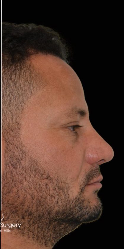 Rhinoplasty Before & After Patient #17759