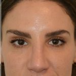 Rhinoplasty Before & After Patient #17772