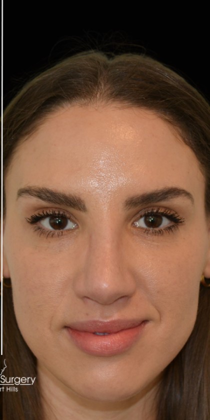 Rhinoplasty Before & After Patient #17772