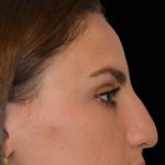 Rhinoplasty Before & After Patient #17772