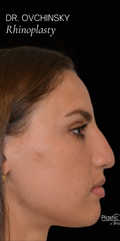 Rhinoplasty Before & After Patient #17772