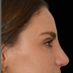 Rhinoplasty Before & After Patient #17772