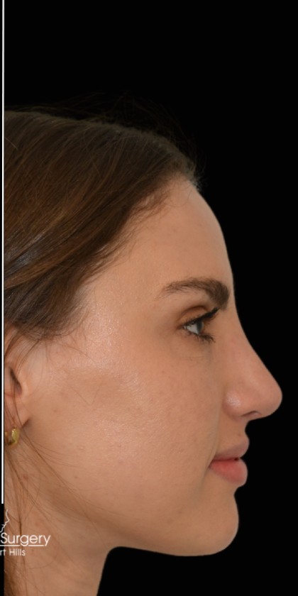 Rhinoplasty Before & After Patient #17772