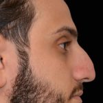 Rhinoplasty Before & After Patient #17758