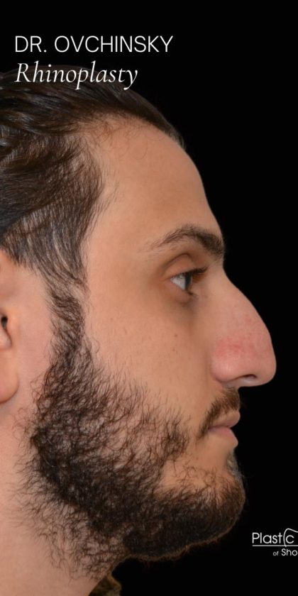 Rhinoplasty Before & After Patient #17758