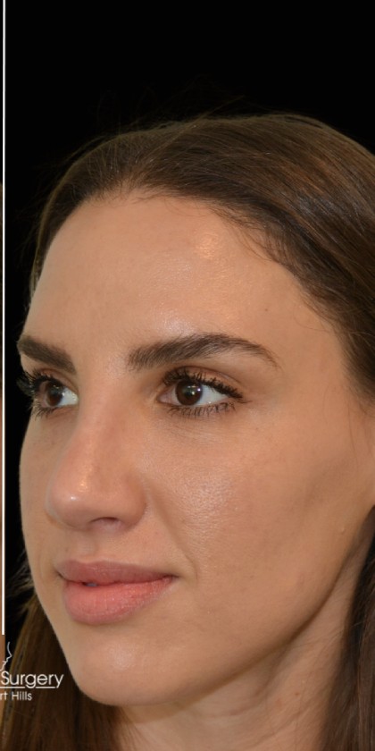 Rhinoplasty Before & After Patient #17772