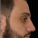 Rhinoplasty Before & After Patient #17758