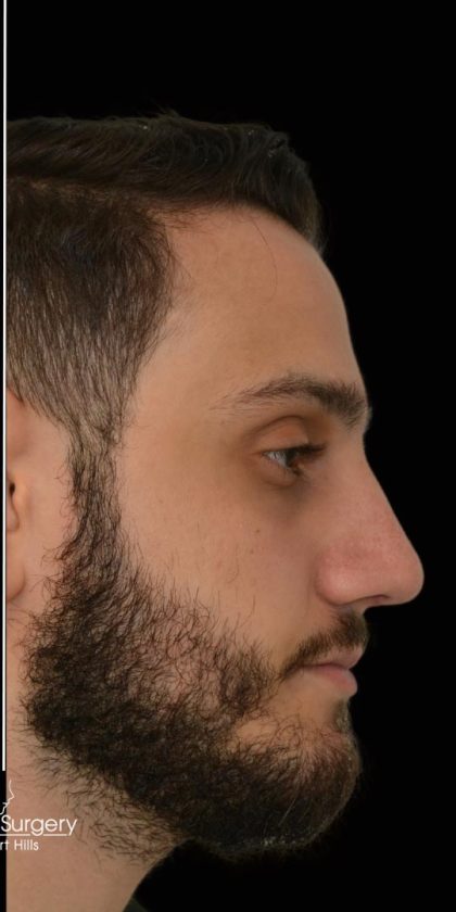 Rhinoplasty Before & After Patient #17758
