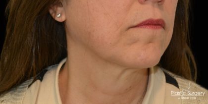 Liposuction-Face Before & After Patient #17790