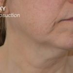 Liposuction-Face Before & After Patient #17790