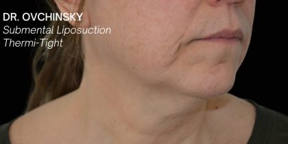 Liposuction-Face Before & After Patient #17790