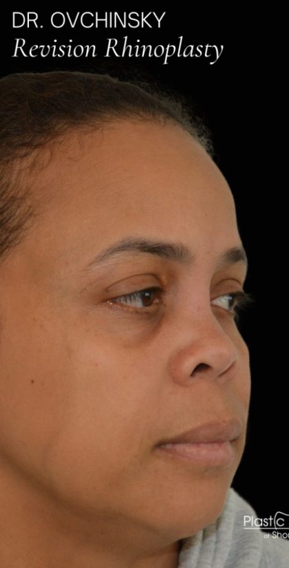 Revision Rhinoplasty Before & After Patient #17779