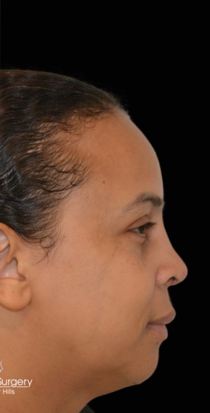 Revision Rhinoplasty Before & After Patient #17779