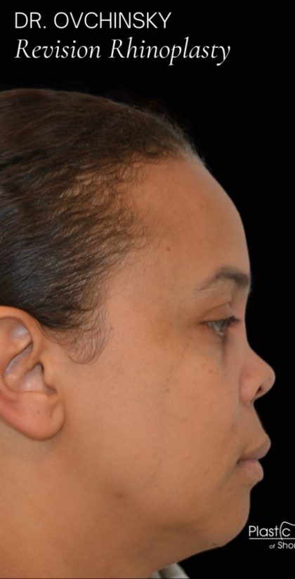 Revision Rhinoplasty Before & After Patient #17779