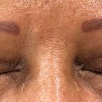 Blepharoplasty Before & After Patient #17785