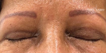 Blepharoplasty Before & After Patient #17785