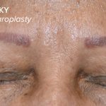 Blepharoplasty Before & After Patient #17785