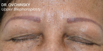 Blepharoplasty Before & After Patient #17785