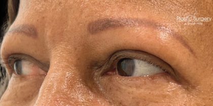 Blepharoplasty Before & After Patient #17785