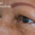 Blepharoplasty Before & After Patient #17785